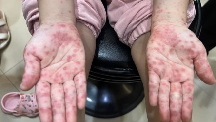 台中補助弱勢嬰幼兒　4/27起接種腸病毒71型疫苗