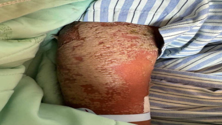 患者全身性膿疱乾癬  醫師：基因突變合併感染新冠