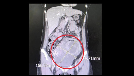 女子腸胃不適揪出16公分巨瘤　罕見罹同步雙癌