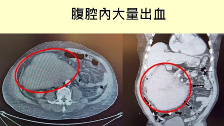 男遭踹一腳險喪命 醫：罕見十二指腸後腹腔大出血
